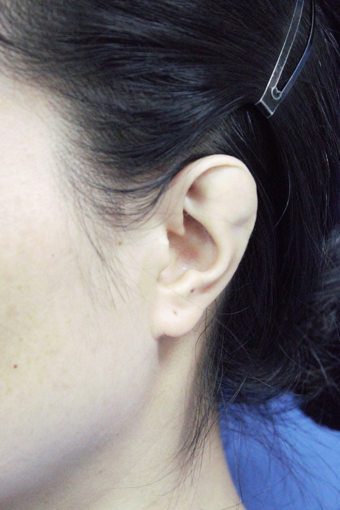 Phẫu thuật cho người phụ nữ 34 tuổi có vành tai khác thường - Ảnh 1.