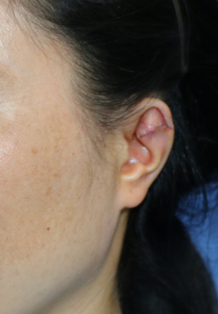 Phẫu thuật cho người phụ nữ 34 tuổi có vành tai khác thường - Ảnh 2.