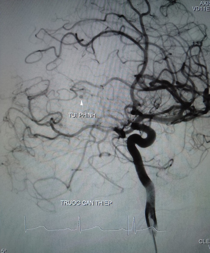 Cứu sống 2 bệnh nhân bị đột quỵ do xuất huyết não - Ảnh 1.