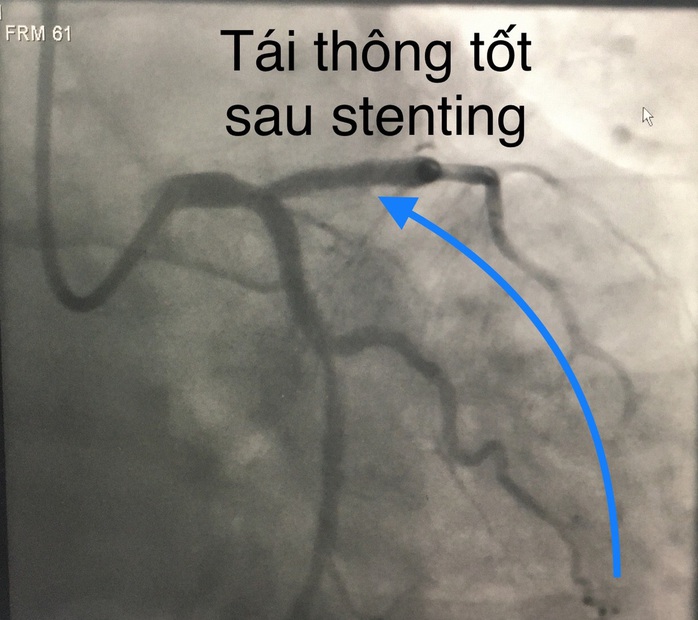 Trong 2 ngày, Bệnh viện ở miền Tây cứu sống 10 bệnh nhân nhồi máu cơ tim  - Ảnh 2.