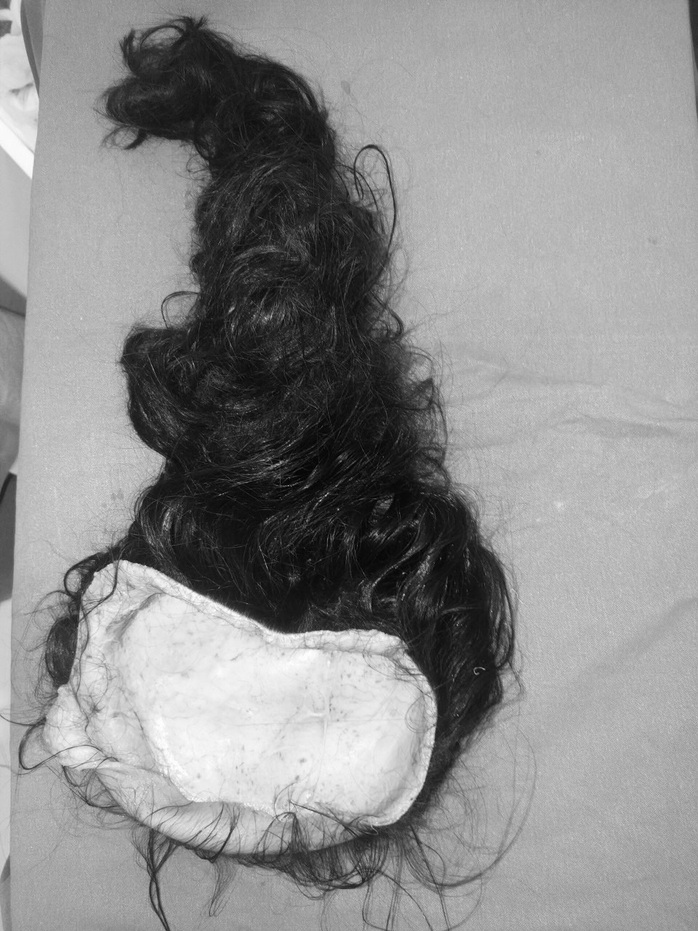 Nối thành công da đầu bị đứt rời cho bé gái 8 tuổi bị tóc cuốn vào xe - Ảnh 1.