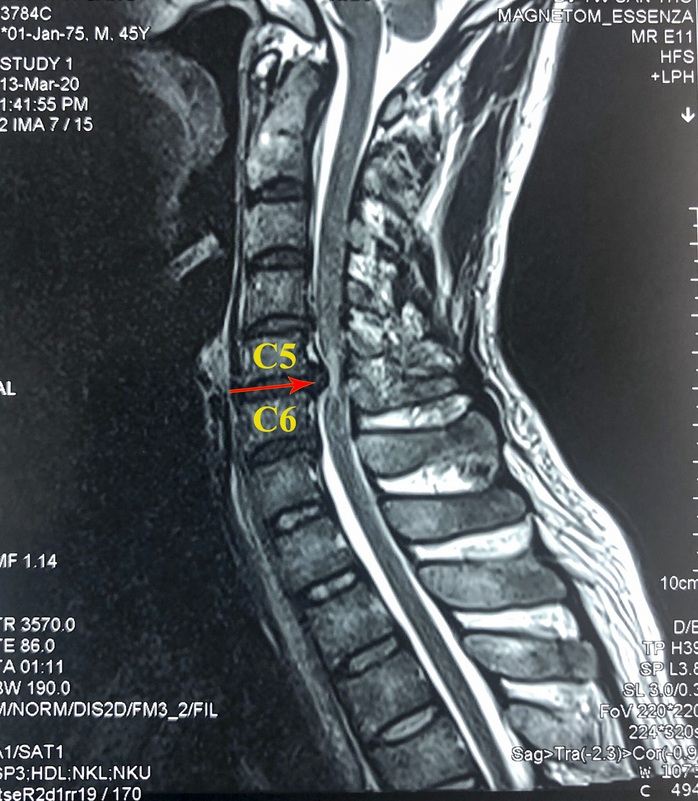 CLIP: Bệnh nhân đầu tiên ở ĐBSCL được thay đĩa đệm nhân tạo cột sống cổ - Ảnh 2.