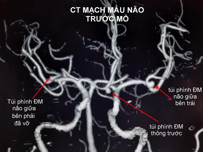 4 giờ căng thẳng giành lấy sự sống cho bệnh nhân tưởng chừng như tử vong - Ảnh 1.