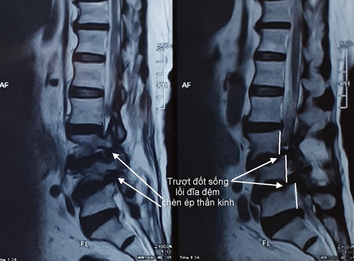 Tin vui từ kỹ thuật hiện đại chữa trị cho bệnh nhân thoát vị đĩa đệm - Ảnh 1.