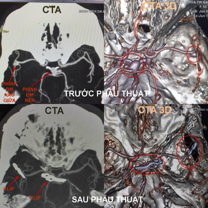 Lần đầu ở ĐBSCL cứu sống 1 người bị phình mạch máu não ở vị trí hiểm - Ảnh 1.