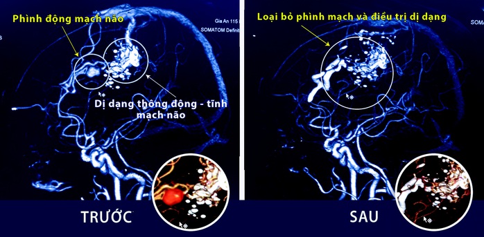 Nút túi phình mạch máu não, cứu cô gái 5 lần đột quỵ - Ảnh 1.