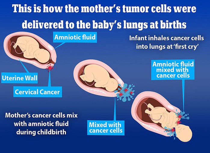 Sốc: 2 trẻ sơ sinh hít phải tế bào ung thư từ mẹ - Ảnh 1.