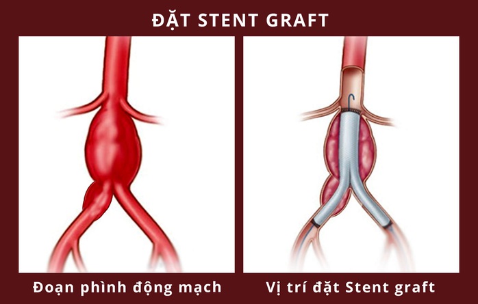 Người đàn ông mạch máu khổng lồ suýt vỡ được cứu như thế nào ? - Ảnh 1.