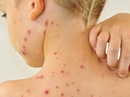 Đề phòng bệnh thủy đậu Đề phòng bệnh thủy đậu