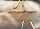 Suýt chết do bị cọc bê tông thúc vào bụng Suýt chết do bị cọc bê tông thúc vào bụng