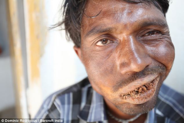 Despite suffering from the condition since the age of 10, Mr Hunagundi claims to have no digestive side effects