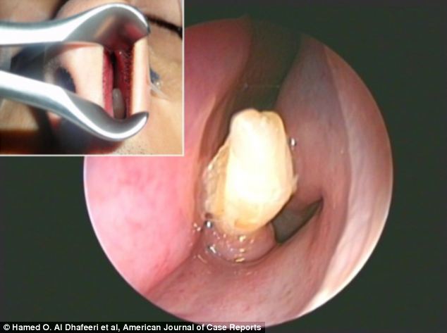 Doctors found a white bony mass measuring half an inch (1cm) long growing in one mans nasal cavity (pictured) which upon closer inspection, dentists proclaimed an extra tooth