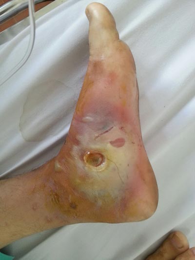 Bàn chân bệnh nhân bị hoại tử nặng  sau 2 tuần vết phỏng không được xử lý đúng cách. (Ảnh do bệnh viện cung cấp)