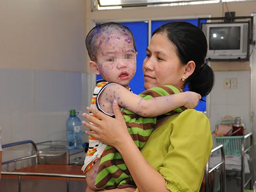 Một trẻ bị bệnh thủy đậu đang được điều trị tại Bệnh viện Nhi Đồng 1 TP HCM
 Ảnh: HỒNG THÚY