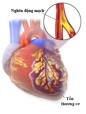 Minh họa tình trạng nhồi máu cơ tim Ảnh: MEDICAL XPRESS