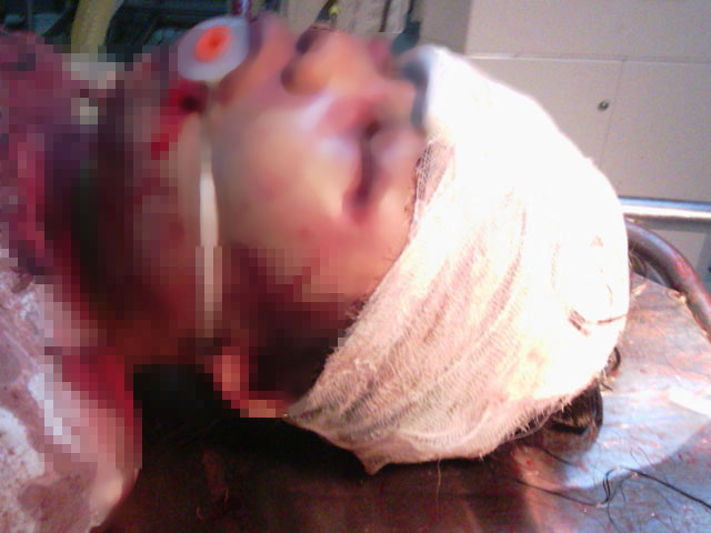 Bé gái Đ.T.O. bị đánh vô cùng dã man với nhiều vết thương trên đầu và mặt. Ảnh gia đình cung cấp