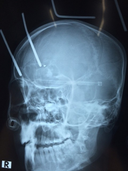 Phim X quang chụp 2 thanh sắt cắm xuyên vào đầu nạn nhân
