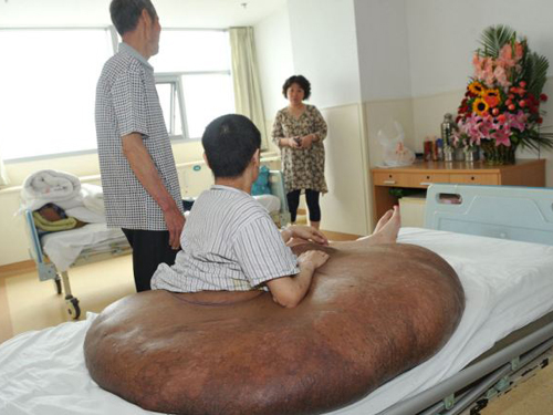 Các bác sĩ ở Bệnh viện Bắc Kinh đã vô cùng ngạc nhiên trước kích cỡ khổng lồ của khối u.
