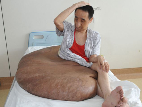 Anh Yang và khối u 110 kg