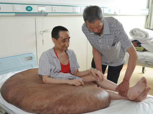 Người đàn ông mang khối u lớn nhất thế giới: 110 kg