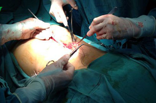Ca mổ cho bệnh nhân Trang A Hỏa bị vỡ gan, vỡ lá lách, chấn thương lồng ngực và gãy xương đùi
