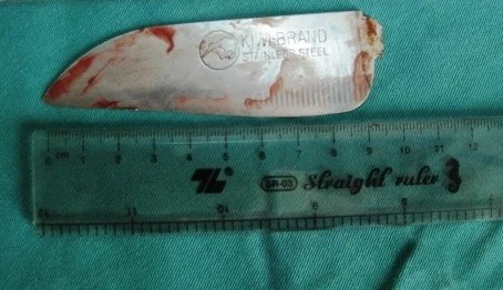 Con dao được các bác sĩ Bệnh viện Đa khoa Thanh Hóa lấy ra từ lưng nạn nhân sau cuộc phẫu thuật kéo dài 4 giờ đồng hồ