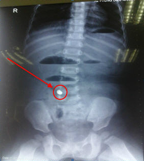 Hình ảnh chụp X-quang cho thấy có hình ảnh của dị vật trong bụng của trẻ,