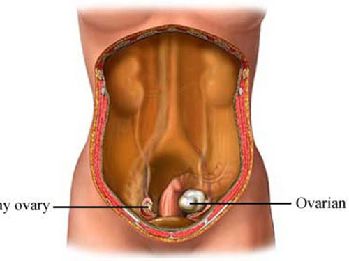 Minh họa so sánh buồng trứng bị ung thư (phải) và buồng trứng lànhẢnh: uvahealth.com