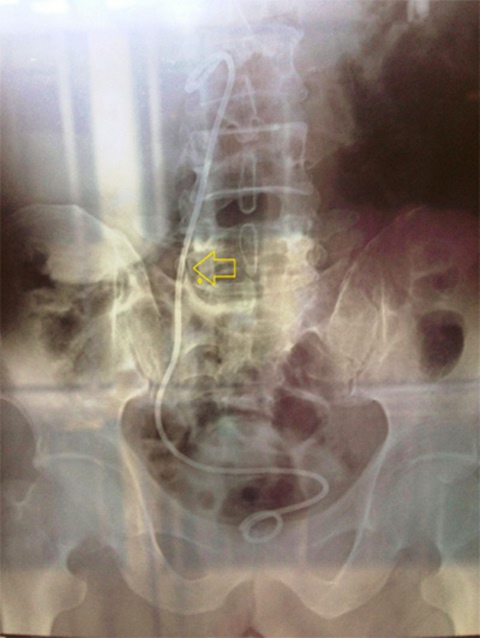 Ảnh chụp X-quang cho thấy dị vật là ống thông nằm trong niệu quản của cụ Đông - Ảnh do bệnh viện cung cấp