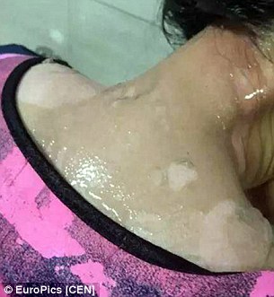 She received extensive burns to her face, neck, shoulders