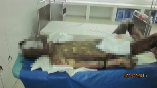 Tuấn bị bỏng toàn thân khi được chuyển đến bệnh viện