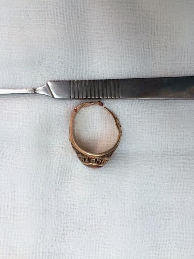 Chiếc nhẫn được cắt ra từ dương vật ông X.