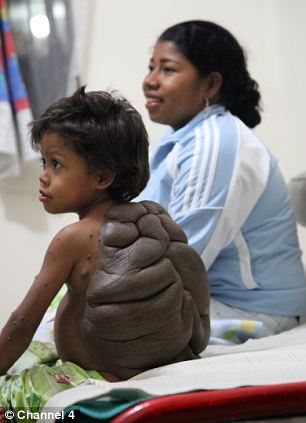 
Turtle Boy người Columbia - bệnh nhi đầu tiên được ghi nhận mắc khối bướu mai rùa và được các bác sĩ người Anh phẫu thuật thành công - ảnh DAILYMAIL
