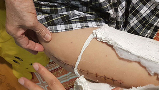 
Cháu Trần Chí Kiên bị gãy chân do bị xe taxi tông trong sân trường
