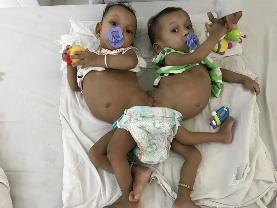 Hai bé song sinh dính liền trước phẫu thuật (Ảnh do bệnh viện cung cấp) 