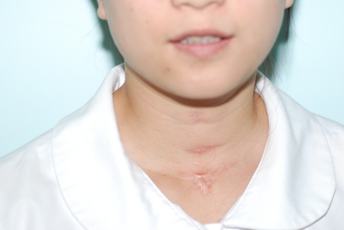 hpv thanh qu n