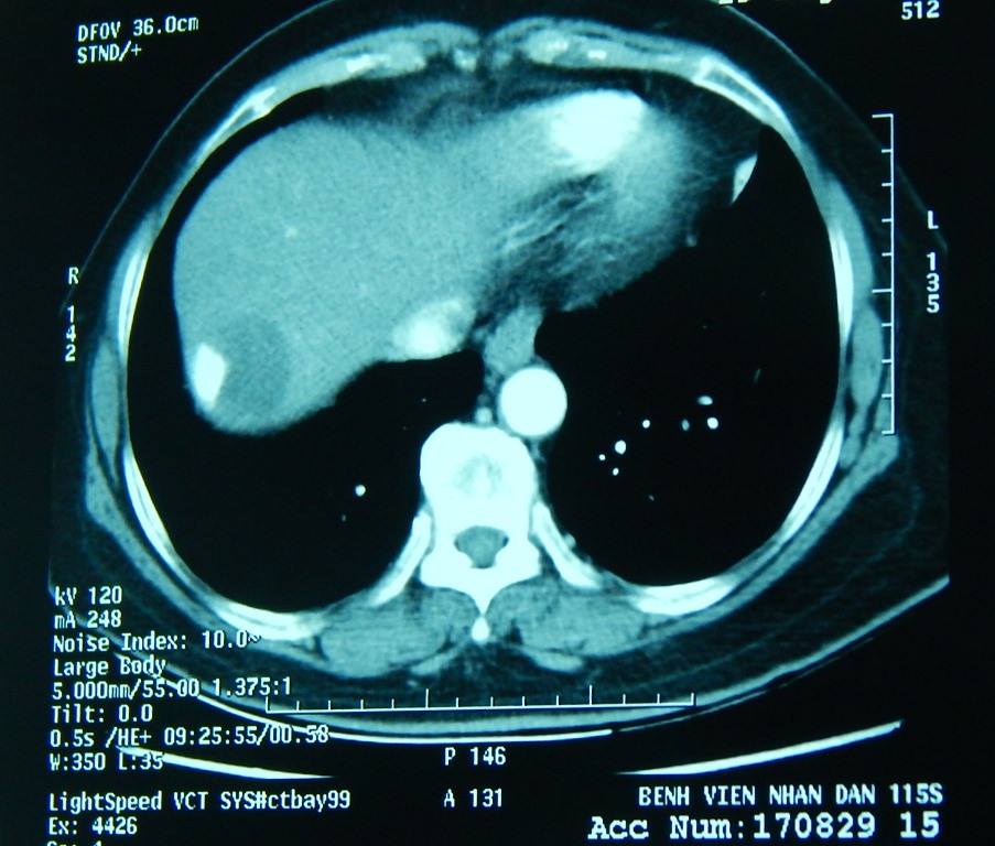 Loại bỏ khối u gan khổng lồ ở bệnh nhân nữ 67 tuổi - Báo Người lao ...