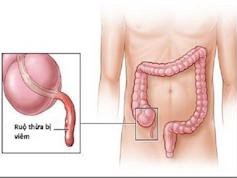 Những dấu hiệu cảnh báo bạn bị viêm ruột thừa