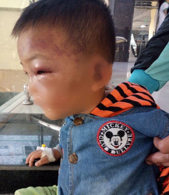 Bé 2 tuổi thâm tím mặt, nhập viện nghi bị bố dượng bạo hành - Ảnh 1.