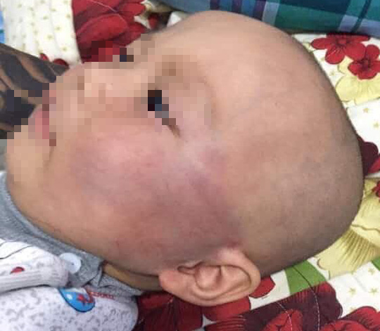 Vụ bé trai 19 tháng bị tát sưng mặt: Đề nghị xử lý bảo mẫu - Ảnh 1.