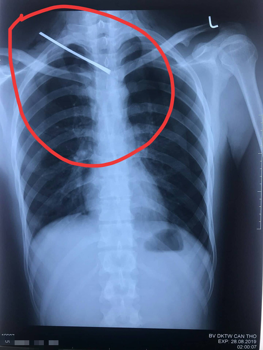 2 giờ phẫu thuật cứu sống 9X bị bạn dùng cây sắt đâm thấu cổ, xuyên phổi - Ảnh 1.