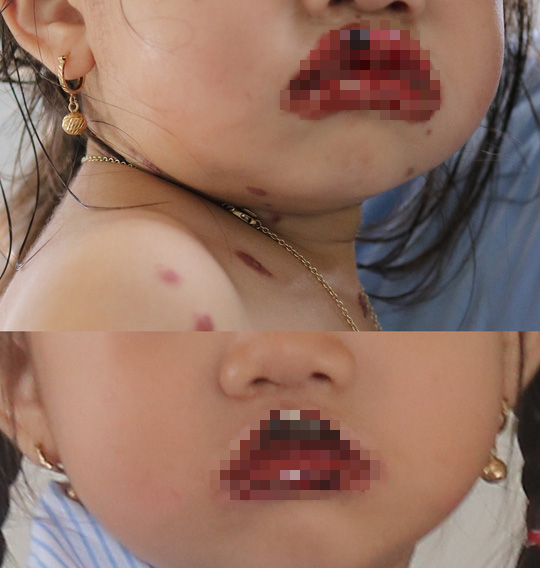 Bé gái 3 tuổi mắc chứng bệnh lạ khiến lở loét toàn bộ 2 môi - Ảnh 3.