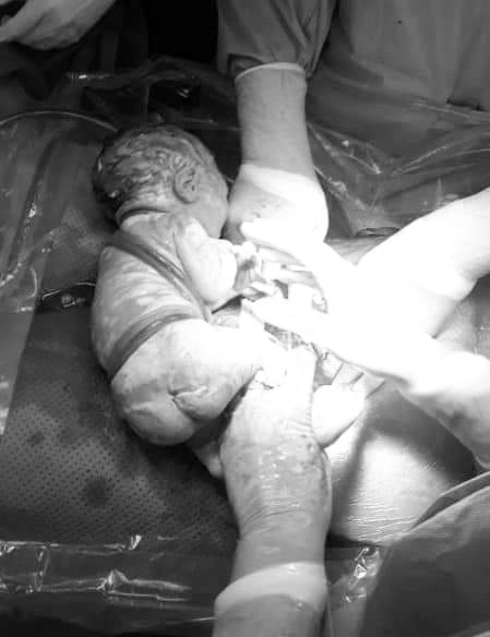 Ngoạn mục đưa bé sơ sinh bị 6 vòng dây rốn quấn cổ, mình ra đời - Ảnh 2.