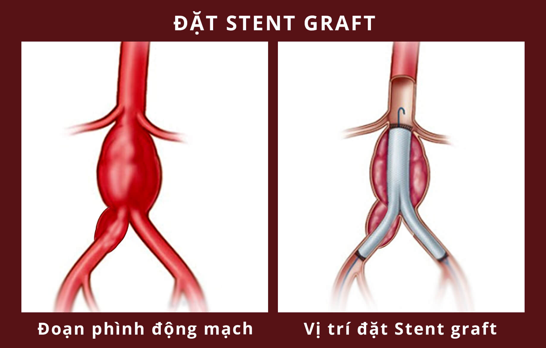 Người đàn ông mạch máu khổng lồ suýt vỡ được cứu thế nào ? - Báo Người lao  động