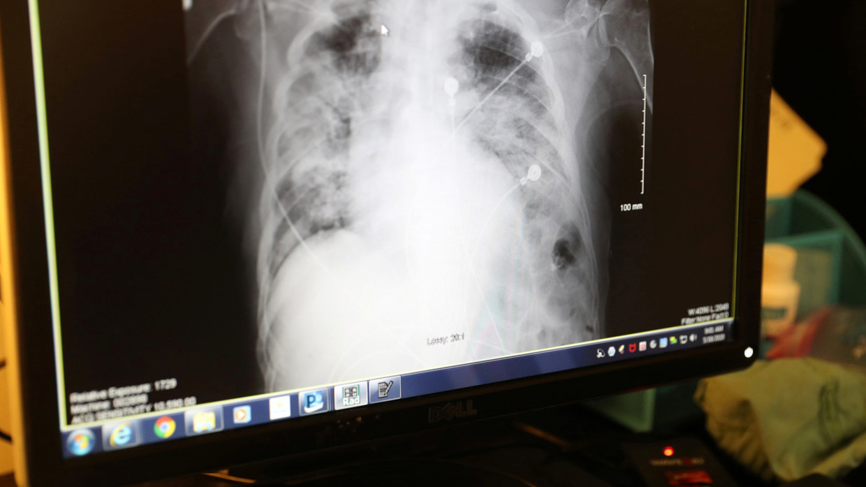 Bệnh nhân xui xẻo, chết vì ghép phổi chứa virus SARS-CoV-2 - Báo ...
