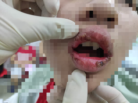 Thiếu nữ 15 tuổi lở loét môi sau khi bôi son - Ảnh 1.