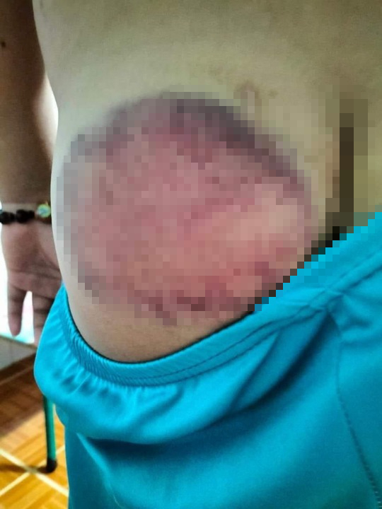 Học sinh tiểu học bị giáo viên đánh bầm tím mông vì nghịch, quên mang sách - Ảnh 1.