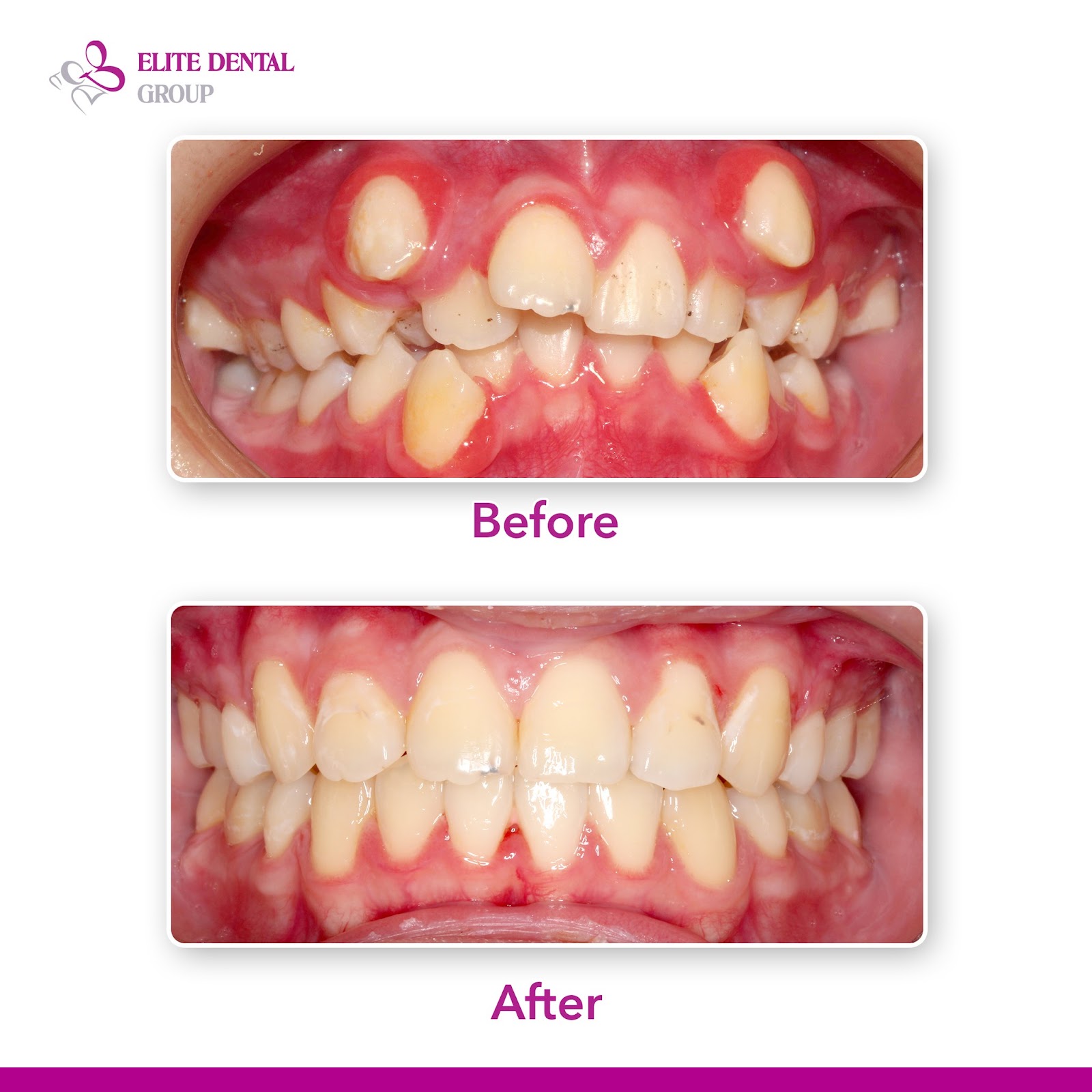 Để có một hành trình niềng răng suôn sẻ, cần lưu ý những điểm sau - Ảnh 1.