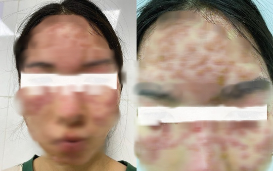 Detox da tại spa, cô gái nhập viện với khuôn mặt đầy mụn - Ảnh 1.