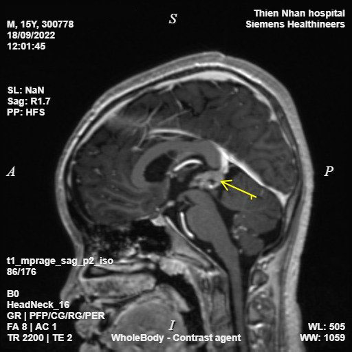 Chụp MRI toàn thân, phát hiện kịp thời ung thư di căn - Ảnh 1.